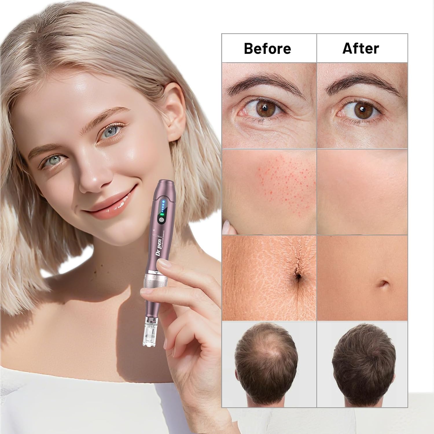 Dr. Pen 2026 Ultima A10 Microneedling Pen, Dermapen mit 25 Ersatzkartuschen – Bild 5