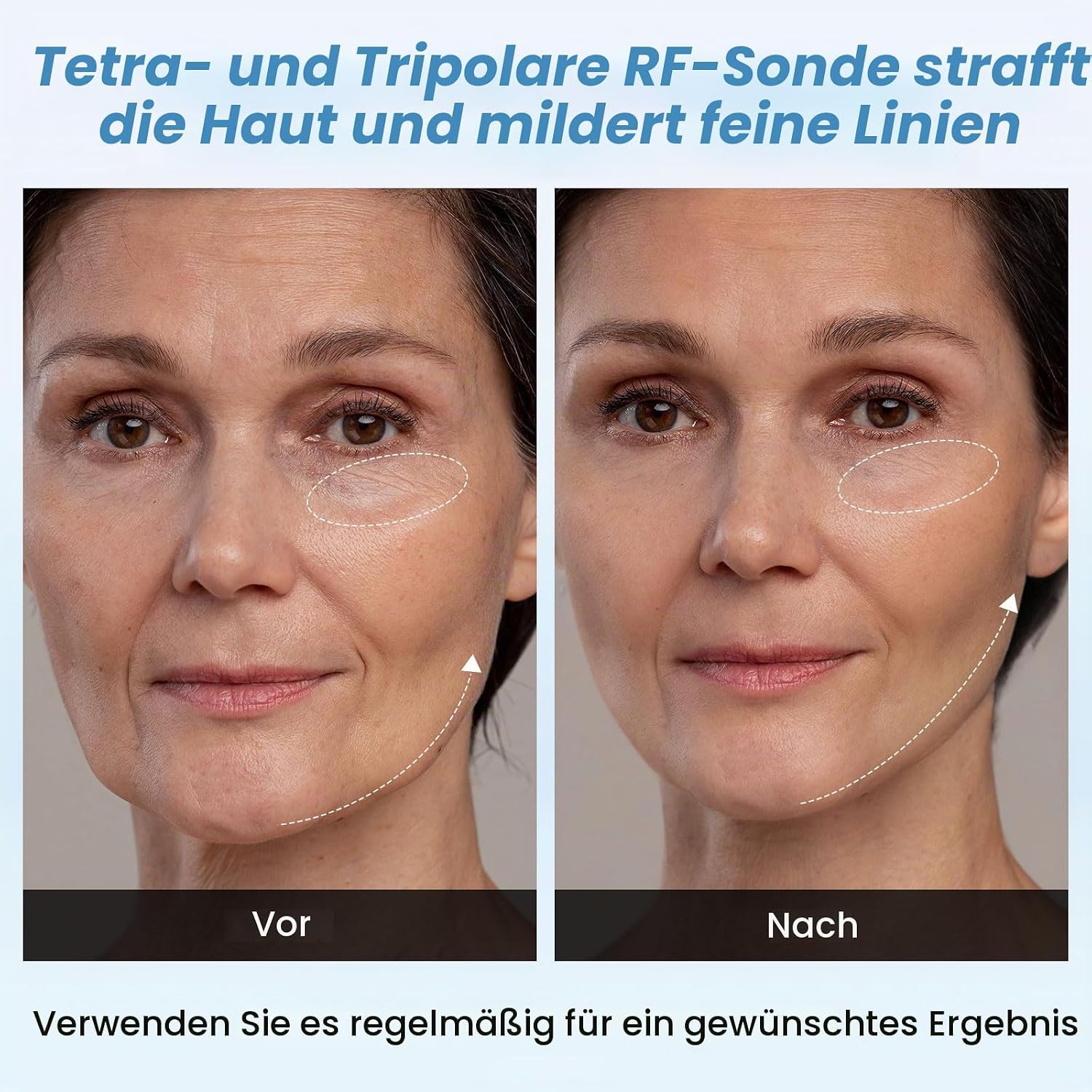 Cellulite Massagegerät 4 in 1 40K Kavitation & Radiofrequenz & Vakuum Gerät – Bild 3