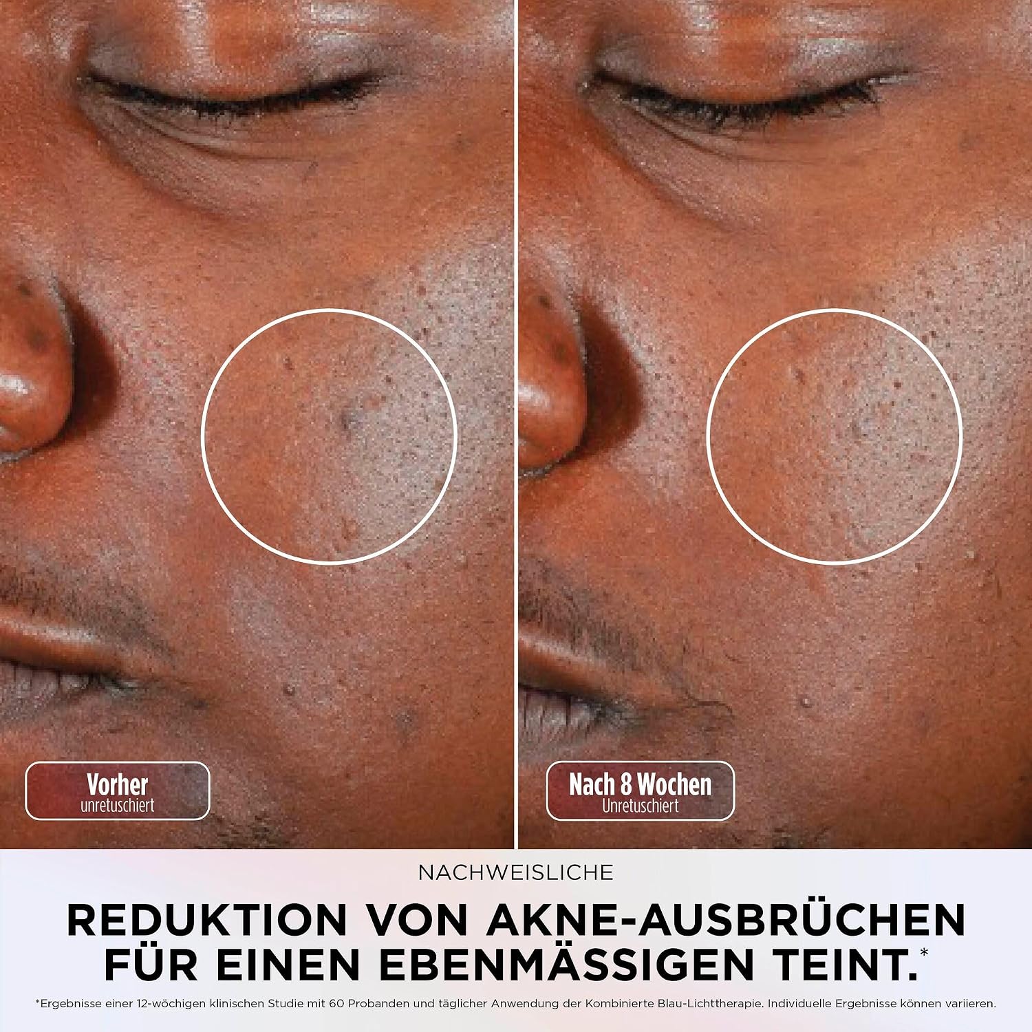 Shark CryoGlow LED-Gesichtsmaske, Augenpartie-Kühlung, Kühles Lila – Bild 11